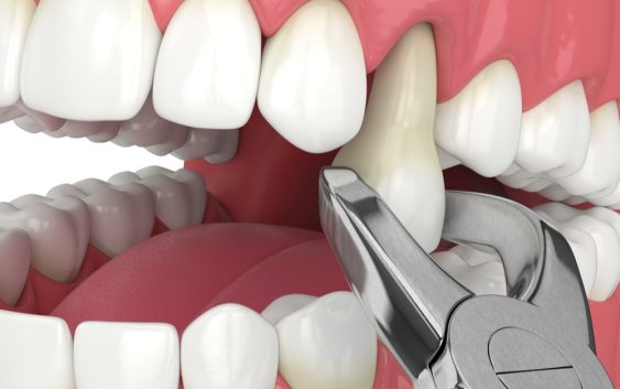 Tips For A Speedy Tooth Extraction Recovery